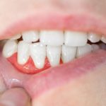 الفرَق بين خراج اللثة وخراج الأسنان