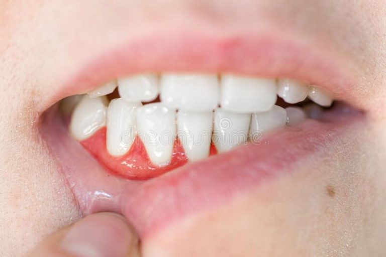 الفرَق بين خراج اللثة وخراج الأسنان